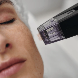 Microneedling